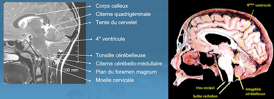 Amygdales neuroanatomie Coupe-cerveau_900x327