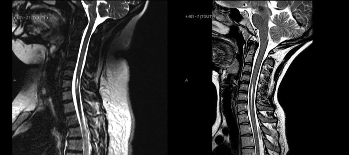 Fentes_01 Fentes médullaires (source @ Centre de référence Chiari-Syringomyélie-Kremlin Bicêtre)