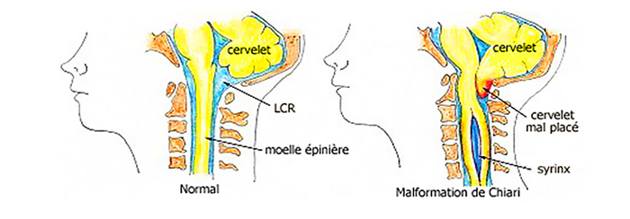 Figure 2 : À gauche, position normale du cervelet permettant l’écoulement du Liquide Céphalo-Spinal (LCS). À droite, malformation de Chiari, avec position anormale du cervelet perturbant la circulation du LCS et créant une cavité au centre de la moëlle épinière (syringomyélie). (source @ http://www.northshorelij.com/body.cfm?ID=6409)