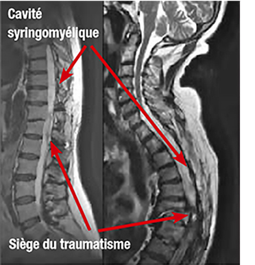 Figure 5 : IRMs de cavités syringomyéliques post-traumatiques. (source @ www.syringomyelie.fr)