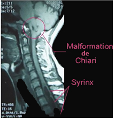 Figure 6 : IRM Syringomyélie avec Chiari. (source @ www.syringomyelie.fr)