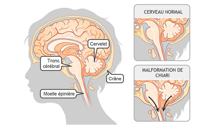 Une malformation de Chiari se produit lorsque le tronc cérébral est situé trop bas dans le crâne de votre enfant ou dans la partie supérieure de la colonne (cou). Li se peut que le tronc cérébral soit comprimé ou écrasé, et qu’il ne fonctionne donc pas adéquatement. (source @ www.syringomyelie.fr)