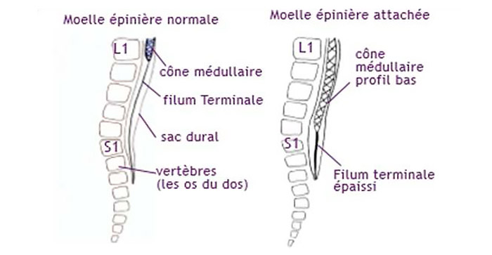 Moelle épinière attachée basse (source @ http://www.cheo.on.ca)