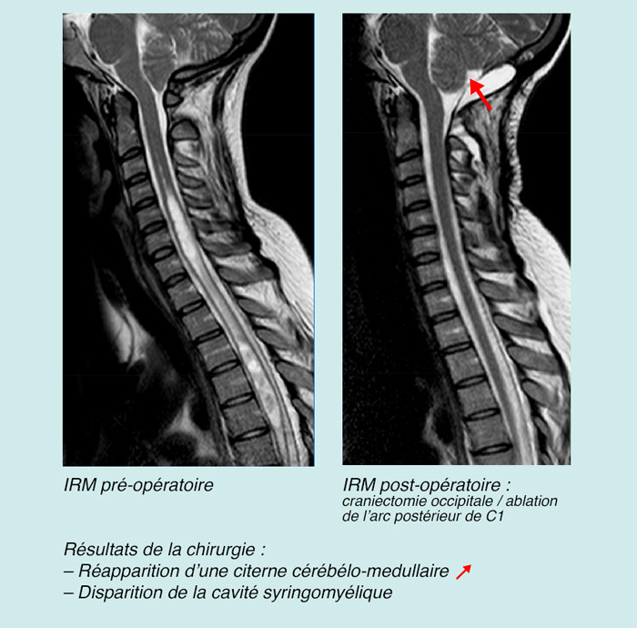 La malformation d'Arnold Chiari – Apaiser